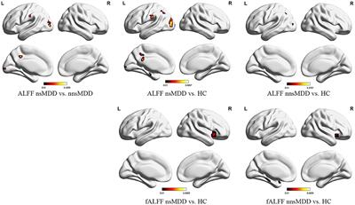 A Resting State Functional Magnetic Resonance Imaging Study of Unmedicated Adolescents With Non-suicidal Self-Injury Behaviors: Evidence From the Amplitude of Low-Frequency Fluctuation and Regional Homogeneity Indicator